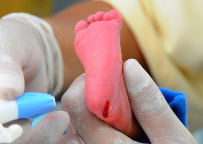 Unidades de saúde de Nova Iguaçu reforçam a importância do Teste do Pezinho